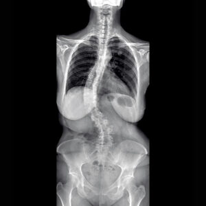 Scoliosis-x-ray-2-GAMMA-scaled