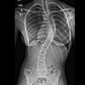 Scoliosis-x-ray-32-GAMMA-scaled