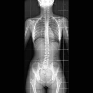 Scoliosis-x-ray-wide-GAMMA-scaled